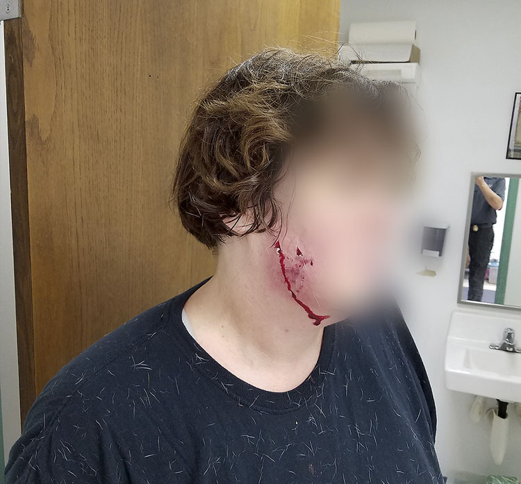 3 dog bite cases reported within a week, 2 at an...