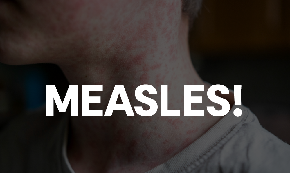 DPH Confirms Fourth Measles Case in Georgia in 2025